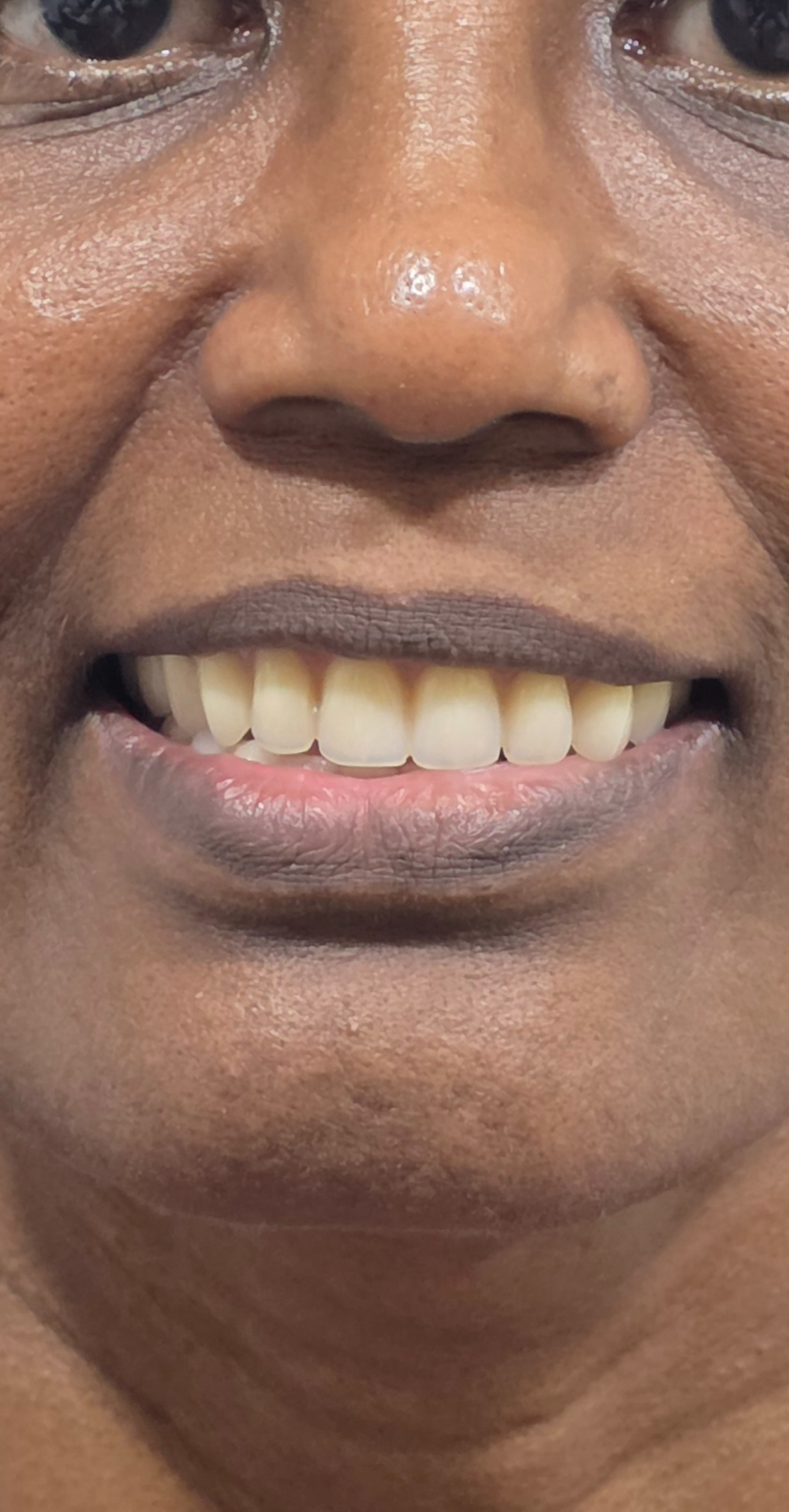 After treatment