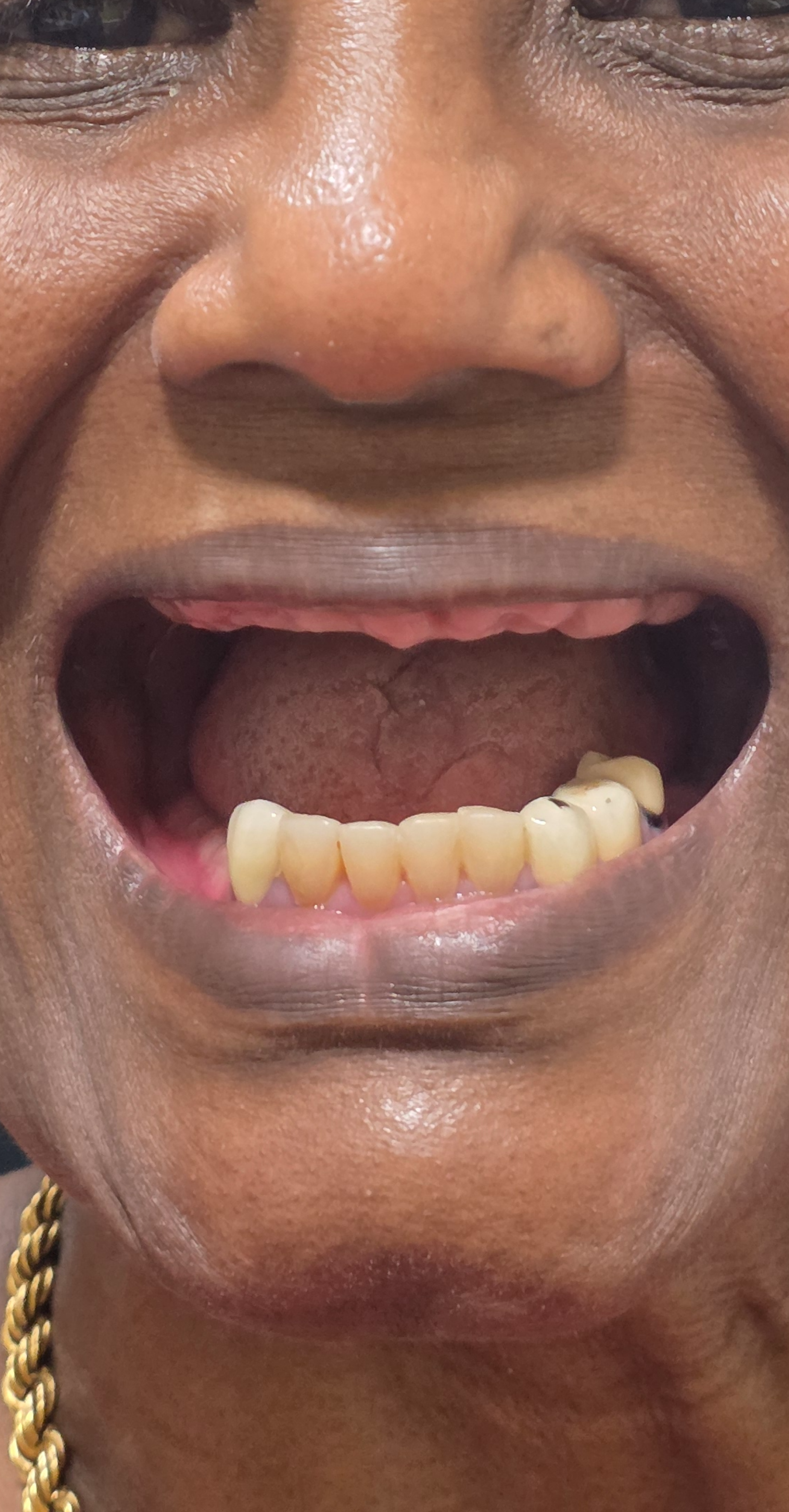 Before treatment