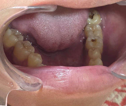 Cavity Assessment at Sans Dental Studio