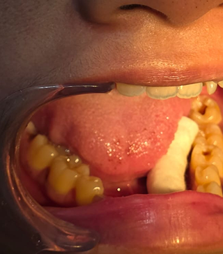 Isolation For Treatment at Sans Dental Studio