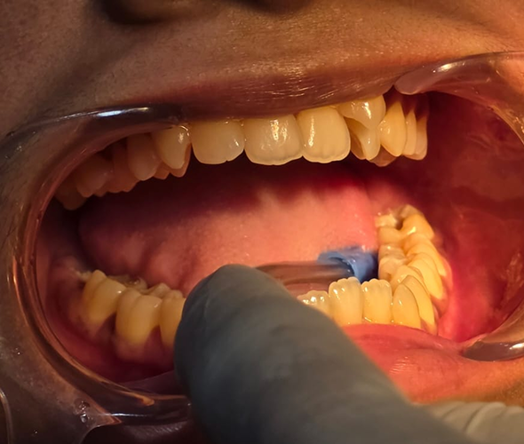 Tooth Preparation at Sans Dental Studio
